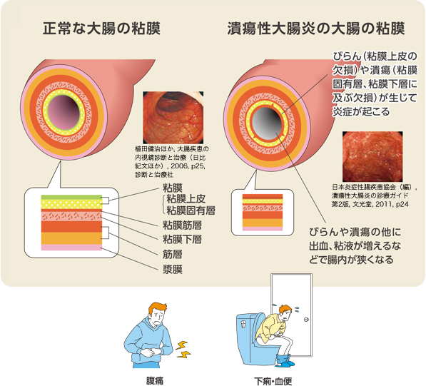 正常な大腸の粘膜　潰瘍性大腸炎の粘膜