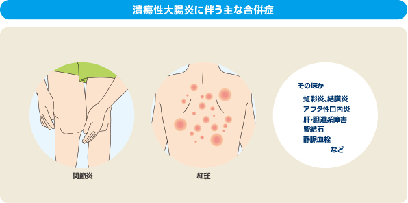 潰瘍性大腸炎に伴う主な合併症