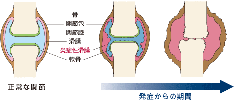 関節破壊の進行