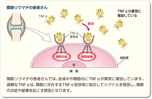 関節リウマチの患者さんでは、血液中や関節内にTNFαが異常に増加しています。過剰なTNFαは、関節に存在するTNFα受容体に結合してシグナルを発信し、関節の炎症や破壊を起こす原因となります。
